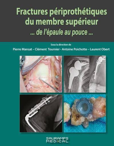 Fractures Periprothetiques du Membre Superieur... De l Epaule au